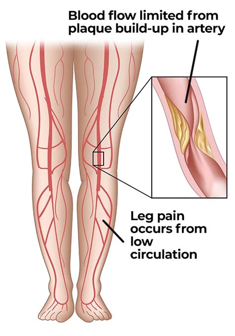 No Circulation In Legs - sinrefarmamiento