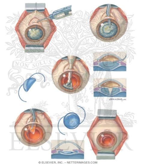 Phacoemulsification