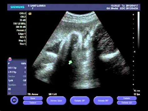 39 week ultrasound - YouTube