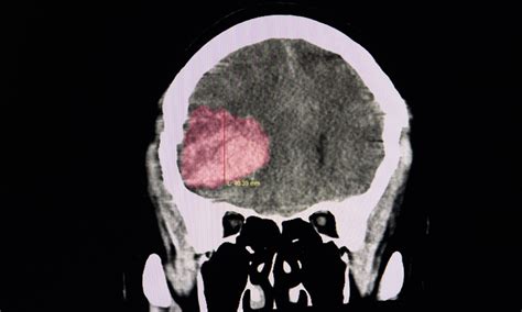 Caplacizumab for thrombotic thrombocytopenic purpura