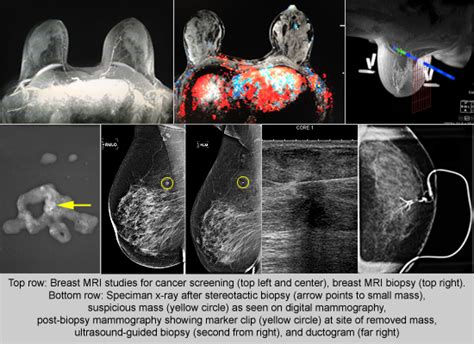 Diagnostic Mammogram Procedure