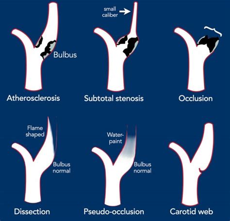 The Radiology Assistant : How to Differentiate Carotid Obstructions