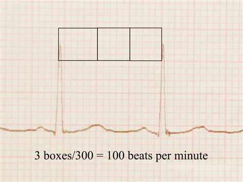 How to Read an EKG: 9 Steps - wikiHow