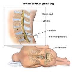 Myelogram | Spinal fluid, Lumbar puncture, Cerebrospinal fluid