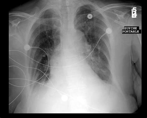 Sternal Fracture | Emory School of Medicine