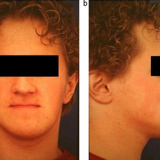 Case 1. Preoperative view (a) occlusion showing a retrognathic maxilla,... | Download Scientific ...