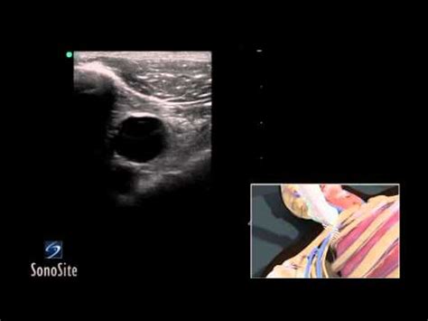 3D How To: Ultrasound Guided Insertion of a Subclavian Vein Catheter ...