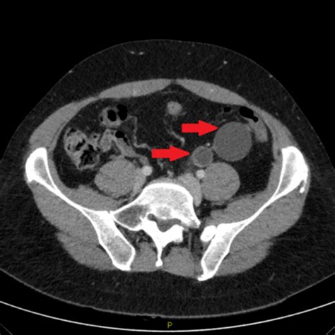 Ureterocele in adult man | Eurorad