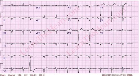 Left Atrial Enlargement with P-Mitrale ECG | Learn the Heart