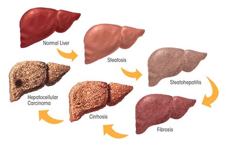 Alcoholic Liver Disease: Pathogenesis and Current Management | Alcohol Research: Current Reviews