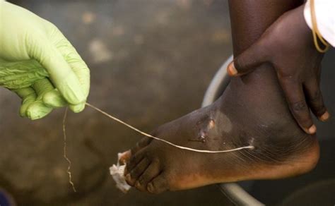 Guinea worm closer to eradication as cases halve in a year - Breitbart