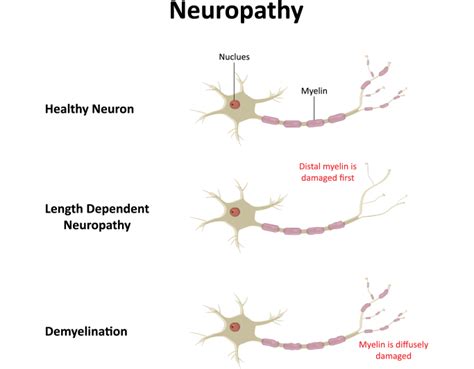 Neuropathic Pain/Peripheral Neuropathy Pain - The Orthopedic Pain ...