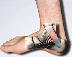 Exercises for Tarsal Tunnel Syndrome