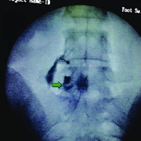 Transforaminal epidural steroid injections procedure done UAAP under... | Download Scientific ...