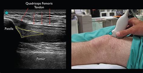 How to Perform Ultrasound-Guided Knee Arthrocentesis - Page 2 of 3 ...