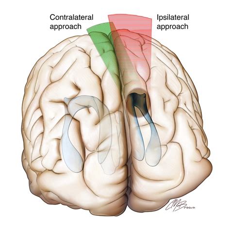 Interhemispheric Craniotomy | The Neurosurgical Atlas