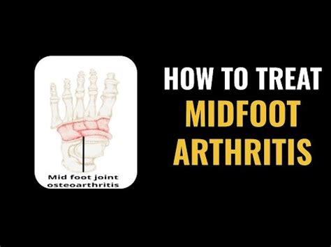 Midfoot Arthritis Treatment Options - Complete Ways to SOLVE MIDFOOT PAIN - YouTube