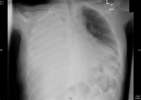 Massive loculated pleural effusion in a patient with pancreatic pseudocyst due to alcohol ...