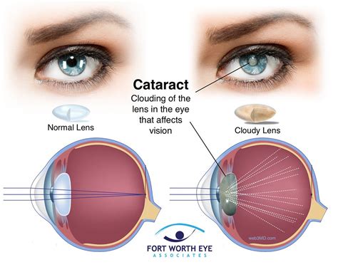 Cataract Surgery Procedure: Safety, Recovery, and Effects