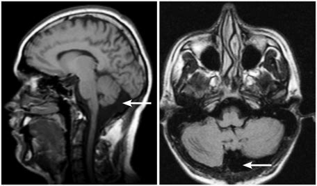 Magnetic resonance imaging midsagital and transverse scans:... | Download Scientific Diagram