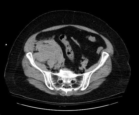 Retroperitoneal hematoma - wikidoc