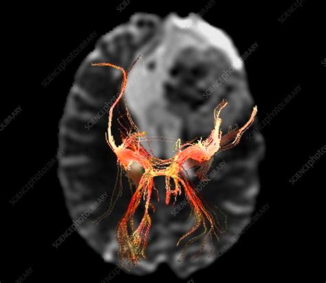 Brain lesion, DTI MRI scan - Stock Image - C057/9275 - Science Photo ...