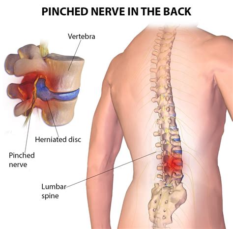 Pinched Nerves Specialists in NYC | New York Pain Care