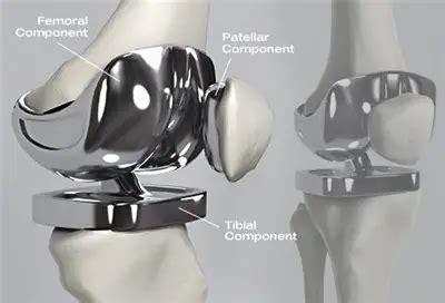 Knee cartilage repair surgery: recovery time & aftercare