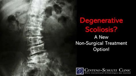 Degenerative Scoliosis? Exciting New Non-surgical Treatment Option