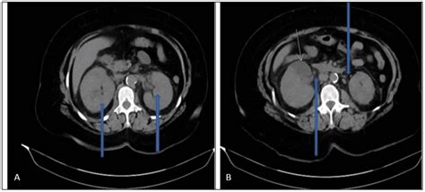 Cureus | Acute Non-Obstructive Bilateral Pyelonephritis With Acute Kidney Injury Requiring ...