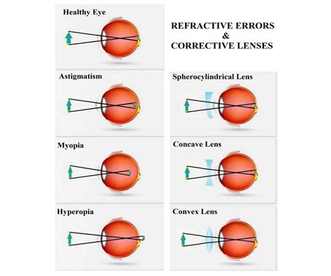 Concave vs. Convex Lens: What's the Difference?