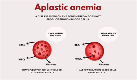 Aplastic Anemia Treatment in Delhi - Dr Vikas Dua