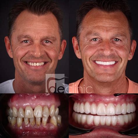 Smile Gallery - Dental Excellence Turkey | Dental Clinic in Antalya Turkey