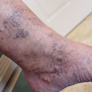 Venous Stasis Dermatitis Treatment | Muto Vein Center