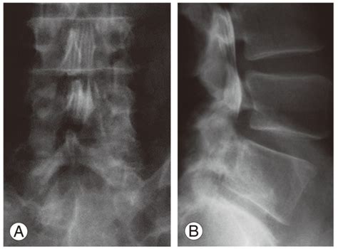 Myelogram of the lumbar spine. (A) Frontal view. (B) Lateral view. | Download Scientific Diagram