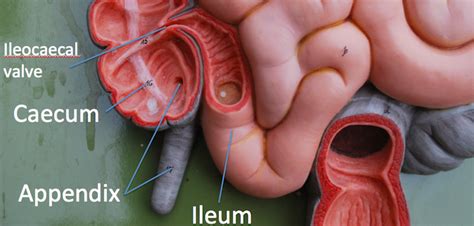 Appendix Cancer - CancerWalls