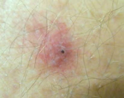 Deer Tick Bite - Pictures, Symptoms, Causes, Treatment