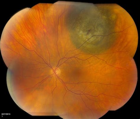 Choroidal Melanoma (Treated) - Retina Image Bank