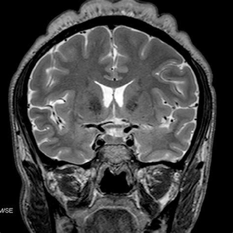 Swelling of soft tissue in the scalp was showed on MRI scan of the head ...