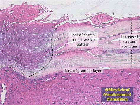 Ichthyosis Vulgaris Histology