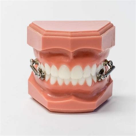 Herbst Appliance - Can Often Correct Severe Overbites without Braces