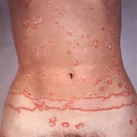 Plaque Psoriasis: Photos and Symptoms From Head to Toe