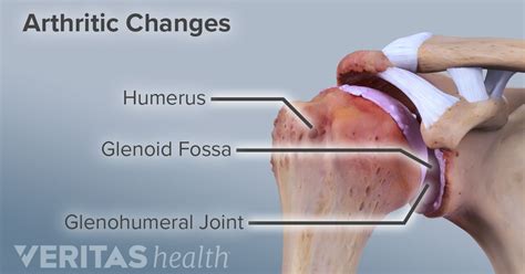 Shoulder Osteoarthritis Diagnosis