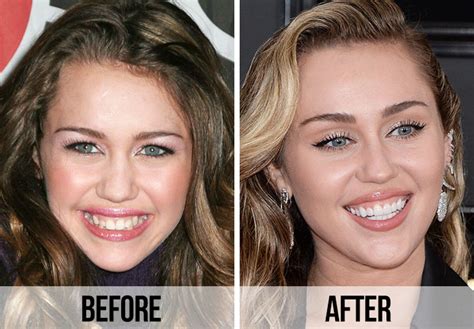 21 Celebrity Dental Implants And Veneers: Before And After - SHEfinds