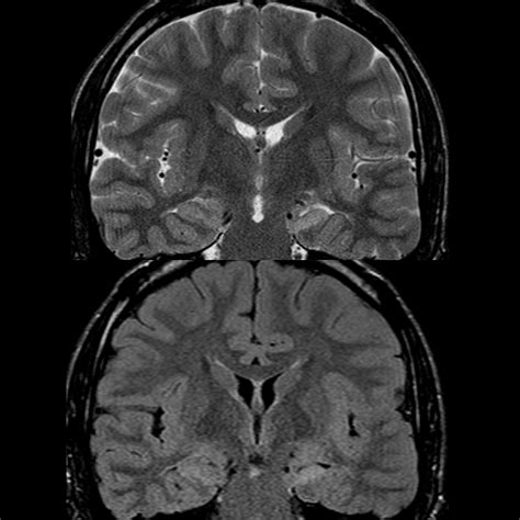 Pediatric Mesial Temporal Sclerosis | Pediatric Radiology Reference Article | Pediatric Imaging ...