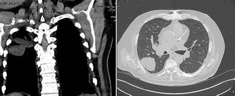 CT scan showing multiple centrilobular nodules in the upper lung zone... | Download Scientific ...