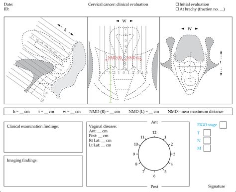 Indian Brachytherapy Society Guidelines for radiotherapeutic management of cervical cancer with ...