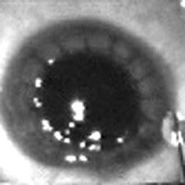 Clinical photograph after completion of keratoplasty. | Download Scientific Diagram