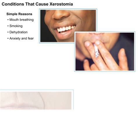 Xerostomia_Causes_from_Disease