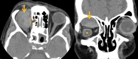 Subperiosteal Orbital Hematoma: An Uncommon Complication of Acute Sinusitis - Journal of ...